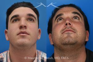 Photo of a patient before and after a procedure. 9 Years Post-Rhinoplasty After Nasal Fracture - These photos show the long-term result—9 years after rhinoplasty to smooth the nasal bridge and refine tip position. The patient had a previous nasal fracture that affected both the appearance and alignment of the nose.
