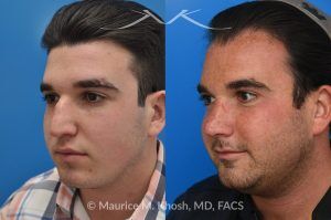 Photo of a patient before and after a procedure. 9 Years Post-Rhinoplasty After Nasal Fracture - These photos show the long-term result—9 years after rhinoplasty to smooth the nasal bridge and refine tip position. The patient had a previous nasal fracture that affected both the appearance and alignment of the nose.