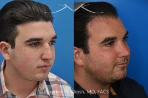 Photo of a patient before and after a procedure. 9 Years Post-Rhinoplasty After Nasal Fracture - These photos show the long-term result—9 years after rhinoplasty to smooth the nasal bridge and refine tip position. The patient had a previous nasal fracture that affected both the appearance and alignment of the nose.
