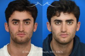 Photo of a patient before and after a procedure. Open Septorhinoplasty for Functional and Aesthetic Correction - This young gentleman presented with significant left-sided nasal obstruction. His goals included improved nasal breathing, a straighter dorsal profile, and elevation of the nasal tip. An open septorhinoplasty was performed, including dorsal reduction, placement of bilateral auto-spreader grafts, an additional spreader graft on the left side, and septo-columellar suture techniques. These measures were utilized to address both functional and aesthetic concerns, resulting in improved airway patency and nasal contour.