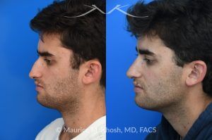 Photo of a patient before and after a procedure. Open Septorhinoplasty for Functional and Aesthetic Correction - This young gentleman presented with significant left-sided nasal obstruction. His goals included improved nasal breathing, a straighter dorsal profile, and elevation of the nasal tip. An open septorhinoplasty was performed, including dorsal reduction, placement of bilateral auto-spreader grafts, an additional spreader graft on the left side, and septo-columellar suture techniques. These measures were utilized to address both functional and aesthetic concerns, resulting in improved airway patency and nasal contour.