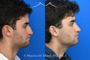 Photo of a patient before and after a procedure. Open Septorhinoplasty for Functional and Aesthetic Correction - This young gentleman presented with significant left-sided nasal obstruction. His goals included improved nasal breathing, a straighter dorsal profile, and elevation of the nasal tip. An open septorhinoplasty was performed, including dorsal reduction, placement of bilateral auto-spreader grafts, an additional spreader graft on the left side, and septo-columellar suture techniques. These measures were utilized to address both functional and aesthetic concerns, resulting in improved airway patency and nasal contour.