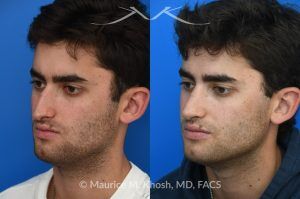 Photo of a patient before and after a procedure. Open Septorhinoplasty for Functional and Aesthetic Correction - This young gentleman presented with significant left-sided nasal obstruction. His goals included improved nasal breathing, a straighter dorsal profile, and elevation of the nasal tip. An open septorhinoplasty was performed, including dorsal reduction, placement of bilateral auto-spreader grafts, an additional spreader graft on the left side, and septo-columellar suture techniques. These measures were utilized to address both functional and aesthetic concerns, resulting in improved airway patency and nasal contour.