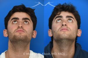 Photo of a patient before and after a procedure. Open Septorhinoplasty for Functional and Aesthetic Correction - This young gentleman presented with significant left-sided nasal obstruction. His goals included improved nasal breathing, a straighter dorsal profile, and elevation of the nasal tip. An open septorhinoplasty was performed, including dorsal reduction, placement of bilateral auto-spreader grafts, an additional spreader graft on the left side, and septo-columellar suture techniques. These measures were utilized to address both functional and aesthetic concerns, resulting in improved airway patency and nasal contour.