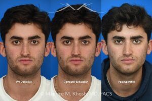 Photo of a patient before and after a procedure. Open Septorhinoplasty for Functional and Aesthetic Correction - This young gentleman presented with significant left-sided nasal obstruction. His goals included improved nasal breathing, a straighter dorsal profile, and elevation of the nasal tip. An open septorhinoplasty was performed, including dorsal reduction, placement of bilateral auto-spreader grafts, an additional spreader graft on the left side, and septo-columellar suture techniques. These measures were utilized to address both functional and aesthetic concerns, resulting in improved airway patency and nasal contour.