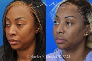 Photo of a patient before and after a procedure. Rhinoplasty to Narrow Nostrils and Bridge of Nose, Neck Liposuction  - before-and-after composite photo.
