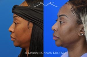 Photo of a patient before and after a procedure. Rhinoplasty to Narrow Nostrils and Bridge of Nose, Neck Liposuction  - before-and-after composite photo.