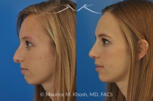 Photo of a patient before and after a procedure. Rhinoplasty to Reduce a Nose Hump, Elevate the Nose Tip, and Refine the Nose Tip - before-and-after composite photo.