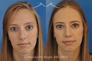 Photo of a patient before and after a procedure. Rhinoplasty to Reduce a Nose Hump, Elevate the Nose Tip, and Refine the Nose Tip - before-and-after composite photo.