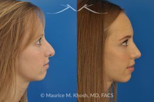 Photo of a patient before and after a procedure. Rhinoplasty to Reduce a Nose Hump, Elevate the Nose Tip, and Refine the Nose Tip - before-and-after composite photo.