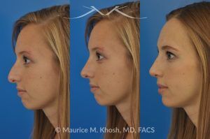 Photo of a patient before and after a procedure. Rhinoplasty to Reduce a Nose Hump, Elevate the Nose Tip, and Refine the Nose Tip - before-and-after composite photo.