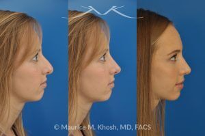 Photo of a patient before and after a procedure. Rhinoplasty to Reduce a Nose Hump, Elevate the Nose Tip, and Refine the Nose Tip - before-and-after composite photo.