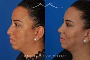 Photo of a patient before and after a procedure. Rhinoplasty to Refine and Elevate the Tip and Eliminate Nasal Hump - This lovely patient sought rhinoplasty in our Manhattan office to address a moderate size hump and to improve the nasal tip. She disliked the droopy nasal tip with poor definition. Rhinoplasty performed through the open approach allowed refinement and rotation of the nasal tip, and smoothing of the nasal hump.