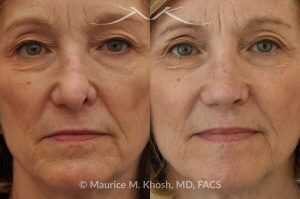 Photo of a patient before and after a procedure. Secondary Repair of Nostril Retraction After Mohs Surgery - This lovely 60 year-old had undergone repair of Mohs cancer removal from the left lower nose, by another surgeon. Unfortunately, this resulted in severe retraction of the left nostril and an unacceptable nasal deformity. 
Rhinoplasty to address nostril retraction was performed in Manhattan. Cartilage graft to the left nostril and composite graft (combination of skin and cartilage graft) to the inside edge of the nostril, helped to restore normality to the nose. The post op pictures are 6 months following her rhinoplasty.