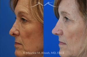 Photo of a patient before and after a procedure. Secondary Repair of Nostril Retraction After Mohs Surgery - This lovely 60 year-old had undergone repair of Mohs cancer removal from the left lower nose, by another surgeon. Unfortunately, this resulted in severe retraction of the left nostril and an unacceptable nasal deformity. 
Rhinoplasty to address nostril retraction was performed in Manhattan. Cartilage graft to the left nostril and composite graft (combination of skin and cartilage graft) to the inside edge of the nostril, helped to restore normality to the nose. The post op pictures are 6 months following her rhinoplasty.
