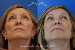 Photo of a patient before and after a procedure. Secondary Repair of Nostril Retraction After Mohs Surgery - This lovely 60 year-old had undergone repair of Mohs cancer removal from the left lower nose, by another surgeon. Unfortunately, this resulted in severe retraction of the left nostril and an unacceptable nasal deformity. 
Rhinoplasty to address nostril retraction was performed in Manhattan. Cartilage graft to the left nostril and composite graft (combination of skin and cartilage graft) to the inside edge of the nostril, helped to restore normality to the nose. The post op pictures are 6 months following her rhinoplasty.