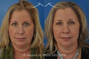 Photo of a patient before and after a procedure. Subtle Rhinoplasty to Correct Nasal Tip Deviation, Reduce Hump, and Refine the Nose - This subtle rhinoplasty procedure addresses the deviation of the nasal tip, reduces a nasal hump, and narrows and elevates the tip for a more balanced and refined appearance.

