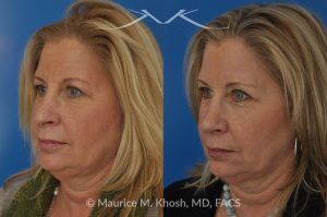 Photo of a patient before and after a procedure. Subtle Rhinoplasty to Correct Nasal Tip Deviation, Reduce Hump, and Refine the Nose - This subtle rhinoplasty procedure addresses the deviation of the nasal tip, reduces a nasal hump, and narrows and elevates the tip for a more balanced and refined appearance.

