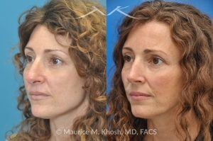 Photo of a patient before and after a procedure. Tip and Bridge Refinement - This young lady requested rhinoplasty to address dorsal hump, wide tip, and hanging columella. Surgery performed through the open rhinoplasty approach.