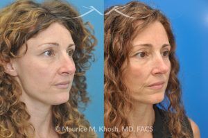 Photo of a patient before and after a procedure. Tip and Bridge Refinement - This young lady requested rhinoplasty to address dorsal hump, wide tip, and hanging columella. Surgery performed through the open rhinoplasty approach.