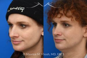 Photo of a patient before and after a procedure. Rhinoplasty to Reduce Nasal Hump and Refine the Tip - This rhinoplasty procedure focused on reducing a prominent nasal hump and refining the nasal tip to create a more balanced and harmonious profile. The result is a natural, proportionate enhancement of the nose.

