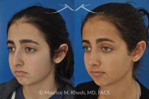 Photo of a patient before and after a procedure. Rhinoplasty for Tip Elevation, Lowering of Nasal Hump, and Narrowing the Nasal Tip - before-and-after composite photo.