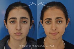 Photo of a patient before and after a procedure. Rhinoplasty for Tip Elevation, Lowering of Nasal Hump, and Narrowing the Nasal Tip - before-and-after composite photo.