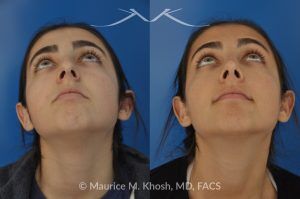 Photo of a patient before and after a procedure. Rhinoplasty for Tip Elevation, Lowering of Nasal Hump, and Narrowing the Nasal Tip - before-and-after composite photo.