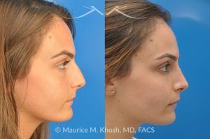 Photo of a patient before and after a procedure. Natural Result After Rhinoplasty for Nose Hump Correction - before-and-after composite photo.