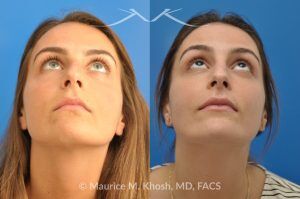 Photo of a patient before and after a procedure. Natural Result After Rhinoplasty for Nose Hump Correction - before-and-after composite photo.