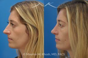 Photo of a patient before and after a procedure. Open Rhinoplasty to Refine a Narrow and Long Nose with Tip Shortening - his 26 year old was interested in nose job in New York, in order to reduce her nasal hump, and make the nasal tip shorter and more refined. She underwent an open approach rhinoplasty which included shortening of the septum, removing the medial crura foot plates, and narrowing the nostrils.