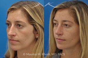 Photo of a patient before and after a procedure. Open Rhinoplasty to Refine a Narrow and Long Nose with Tip Shortening - his 26 year old was interested in nose job in New York, in order to reduce her nasal hump, and make the nasal tip shorter and more refined. She underwent an open approach rhinoplasty which included shortening of the septum, removing the medial crura foot plates, and narrowing the nostrils.