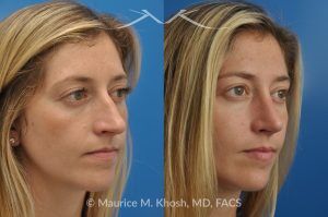Photo of a patient before and after a procedure. Open Rhinoplasty to Refine a Narrow and Long Nose with Tip Shortening - his 26 year old was interested in nose job in New York, in order to reduce her nasal hump, and make the nasal tip shorter and more refined. She underwent an open approach rhinoplasty which included shortening of the septum, removing the medial crura foot plates, and narrowing the nostrils.