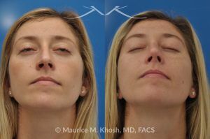 Photo of a patient before and after a procedure. Open Rhinoplasty to Refine a Narrow and Long Nose with Tip Shortening - his 26 year old was interested in nose job in New York, in order to reduce her nasal hump, and make the nasal tip shorter and more refined. She underwent an open approach rhinoplasty which included shortening of the septum, removing the medial crura foot plates, and narrowing the nostrils.