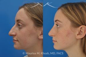 Photo of a patient before and after a procedure. Nose Job to Refine and Elevate Tip and Reduce a Hump - This 19 year old wanted rhinoplasty in New York City to address a droopy nasal tip, and a nasal hump. She disliked the movement of the tip of her nose when she smiled. She was treated with open rhinoplasty which allowed dorsal reduction, bilateral cartilage spreader grafts and alar rim grafts (to maintain breathing), and tip narrowing.