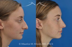 Photo of a patient before and after a procedure. Nose Job to Refine and Elevate Tip and Reduce a Hump - This 19 year old wanted rhinoplasty in New York City to address a droopy nasal tip, and a nasal hump. She disliked the movement of the tip of her nose when she smiled. She was treated with open rhinoplasty which allowed dorsal reduction, bilateral cartilage spreader grafts and alar rim grafts (to maintain breathing), and tip narrowing.