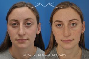 Photo of a patient before and after a procedure. Nose Job to Refine and Elevate Tip and Reduce a Hump - This 19 year old wanted rhinoplasty in New York City to address a droopy nasal tip, and a nasal hump. She disliked the movement of the tip of her nose when she smiled. She was treated with open rhinoplasty which allowed dorsal reduction, bilateral cartilage spreader grafts and alar rim grafts (to maintain breathing), and tip narrowing.