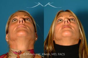 Photo of a patient before and after a procedure. Rhinoplasty for Tip & Dorsum - This patient was interested in addressing the hump on her nose and reducing the columellar show (hanging columella). Surgery was performed via the closed rhinoplasty approach.