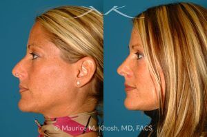 Photo of a patient before and after a procedure. Rhinoplasty for Tip & Dorsum - This patient was interested in addressing the hump on her nose and reducing the columellar show (hanging columella). Surgery was performed via the closed rhinoplasty approach.