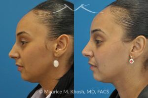 Photo of a patient before and after a procedure. Rhinoplasty to Remove Nasal Hump - This young lady with Hispanic ethnicity was interested in removing a small hump in the nose. Rhinoplasty was performed through a closed (endonasal) approach.