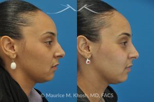 Photo of a patient before and after a procedure. Rhinoplasty to Remove Nasal Hump - This young lady with Hispanic ethnicity was interested in removing a small hump in the nose. Rhinoplasty was performed through a closed (endonasal) approach.