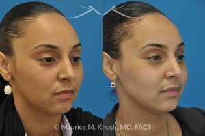 Photo of a patient before and after a procedure. Rhinoplasty to Remove Nasal Hump - This young lady with Hispanic ethnicity was interested in removing a small hump in the nose. Rhinoplasty was performed through a closed (endonasal) approach.