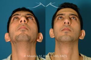 Photo of a patient before and after a procedure. Rhinoplasty and Chin Implant - before-and-after composite photo.