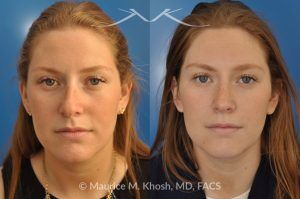 Photo of a patient before and after a procedure. Rhinoplasty to Correct Crooked Nose and Remove Hump - 26 year old with crooked nose to the right side and a small hump. She was seeking rhinoplasty in Manhattan to straighten the nose remove a hump. She was treated with closed rhinoplasty which allowed reduction of the hump, a cartilage spreader graft on the left side, and a columellar strut.