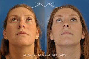 Photo of a patient before and after a procedure. Rhinoplasty to Correct Crooked Nose and Remove Hump - 26 year old with crooked nose to the right side and a small hump. She was seeking rhinoplasty in Manhattan to straighten the nose remove a hump. She was treated with closed rhinoplasty which allowed reduction of the hump, a cartilage spreader graft on the left side, and a columellar strut.