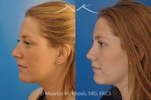 Photo of a patient before and after a procedure. Rhinoplasty to Correct Crooked Nose and Remove Hump - 26 year old with crooked nose to the right side and a small hump. She was seeking rhinoplasty in Manhattan to straighten the nose remove a hump. She was treated with closed rhinoplasty which allowed reduction of the hump, a cartilage spreader graft on the left side, and a columellar strut.