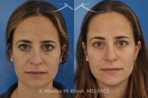 Photo of a patient before and after a procedure. Rhinoplasty for Bridge Straightening and Functional Correction - This procedure corrected the nasal bridge asymmetry and improved the patient’s breathing function.