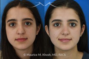 Photo of a patient before and after a procedure. Rhinoplasty to Remove Dorsal Hump and Refine Nasal Tip - This 18 year-old was interested in rhinoplasty in New York to eliminate her nasal hump, narrow and refine the tip, and address deviated septum which caused breathing obstruction and asymmetric nostrils. An open approach rhinoplasty was used to address all her concerns. 