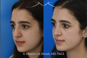 Photo of a patient before and after a procedure. Rhinoplasty to Remove Dorsal Hump and Refine Nasal Tip - This 18 year-old was interested in rhinoplasty in New York to eliminate her nasal hump, narrow and refine the tip, and address deviated septum which caused breathing obstruction and asymmetric nostrils. An open approach rhinoplasty was used to address all her concerns. 