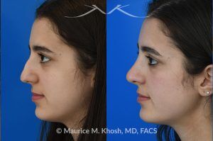 Photo of a patient before and after a procedure. Rhinoplasty to Remove Dorsal Hump and Refine Nasal Tip - This 18 year-old was interested in rhinoplasty in New York to eliminate her nasal hump, narrow and refine the tip, and address deviated septum which caused breathing obstruction and asymmetric nostrils. An open approach rhinoplasty was used to address all her concerns. 